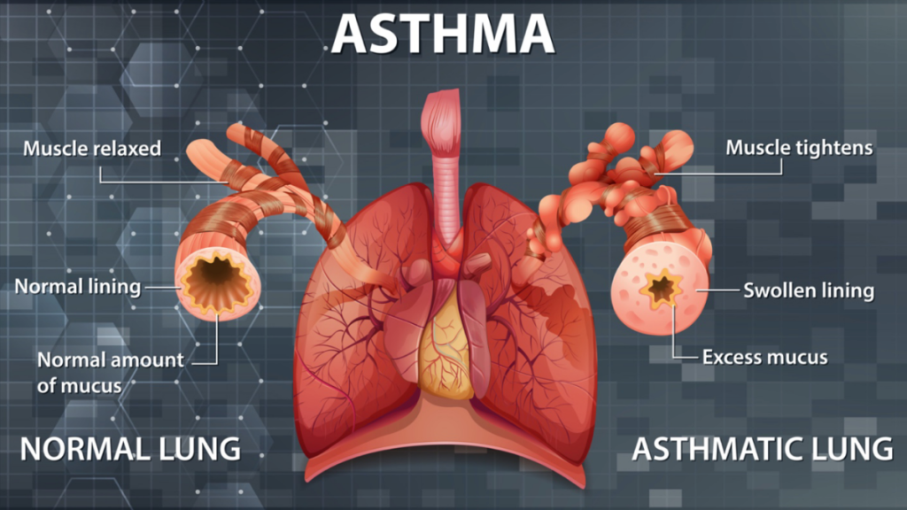 5 Yoga Poses for Getting Relief from Asthma