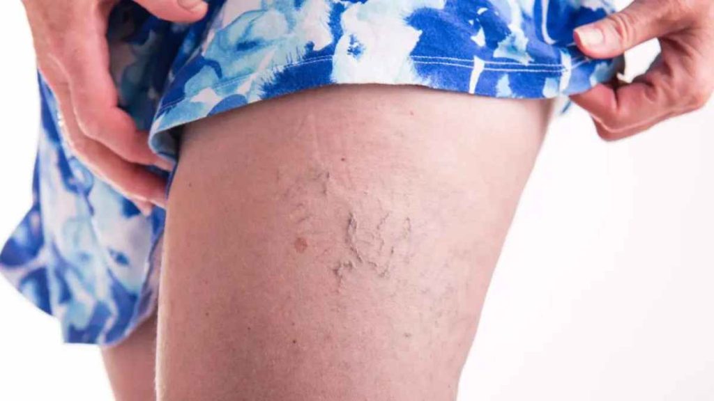 Various Treatments For Varicose Veins