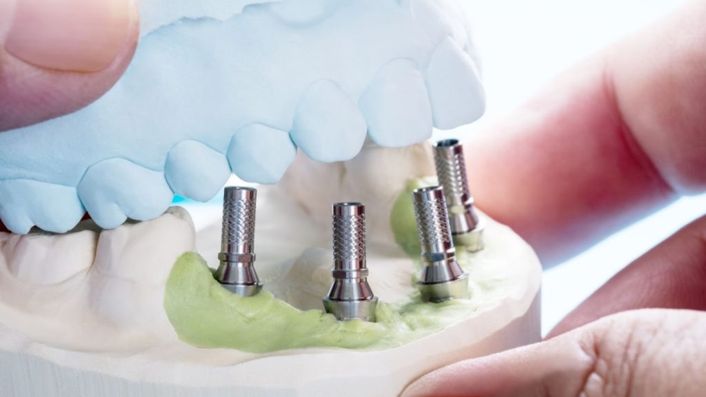 Advantages of Dental Implants